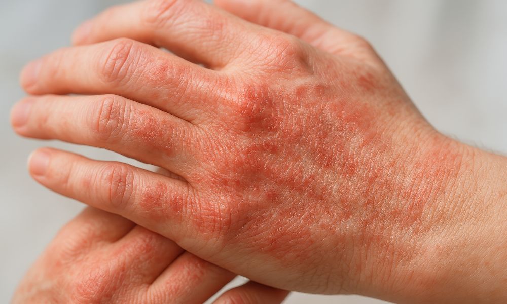 Ekcéma tünetei - Mire figyelmeztet a bőr és hogyan kezelhető tudatosan?